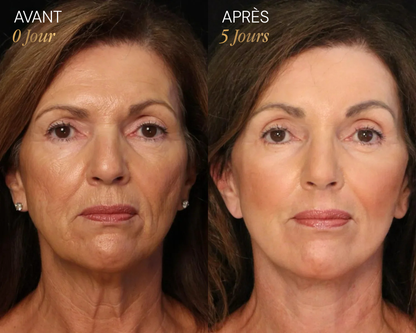 Brosse lymphatique Vyoom pour le visage